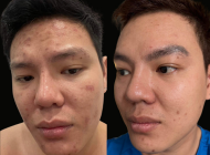 Image of before and 4 days post microneedling