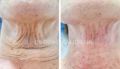 Image of before and after 1 Plasma Roll treatment
