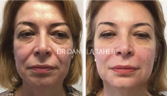 Image of before and after 1 FACETIM treatment