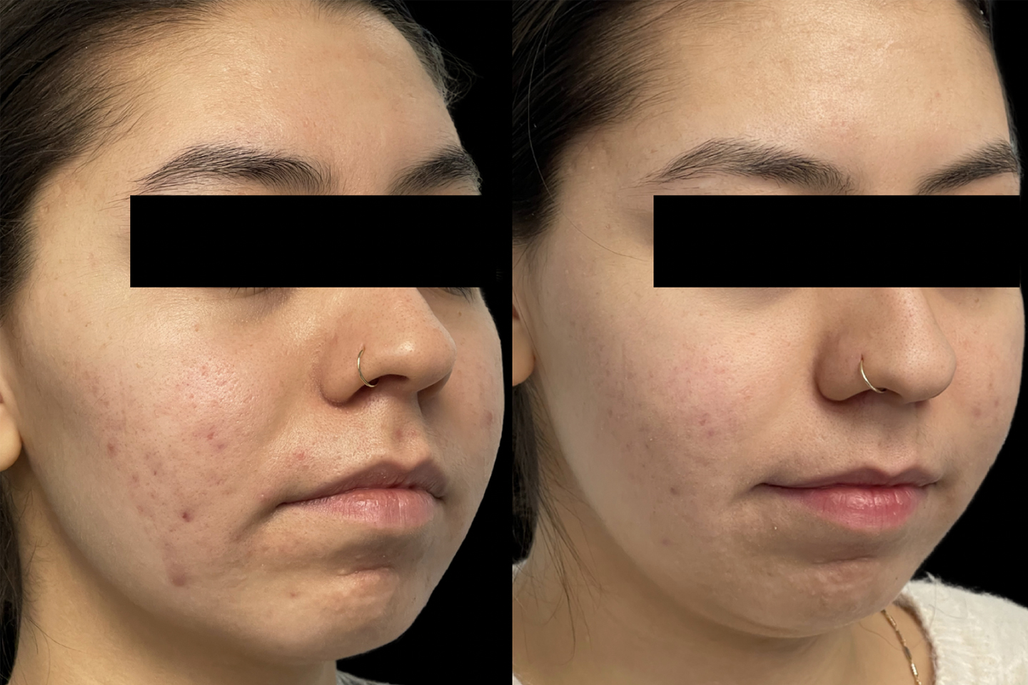 Image of before and 2 weeks post 2 treatments