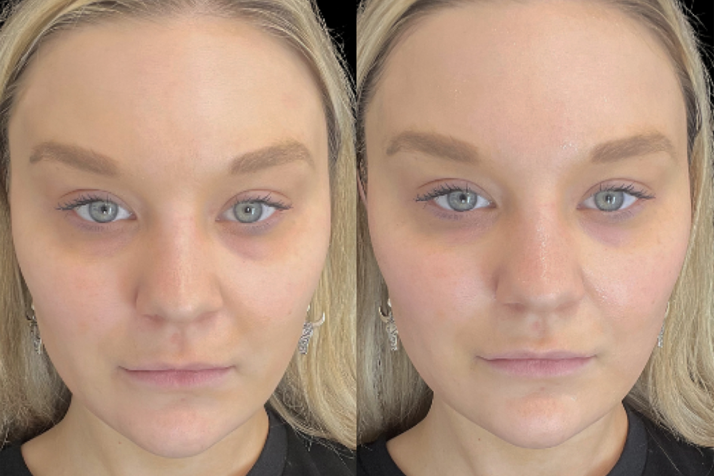 Image of before and immediately post treatment