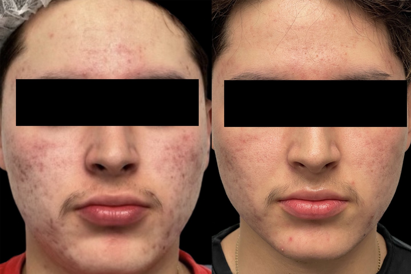 Image of before and 4 weeks post treatment