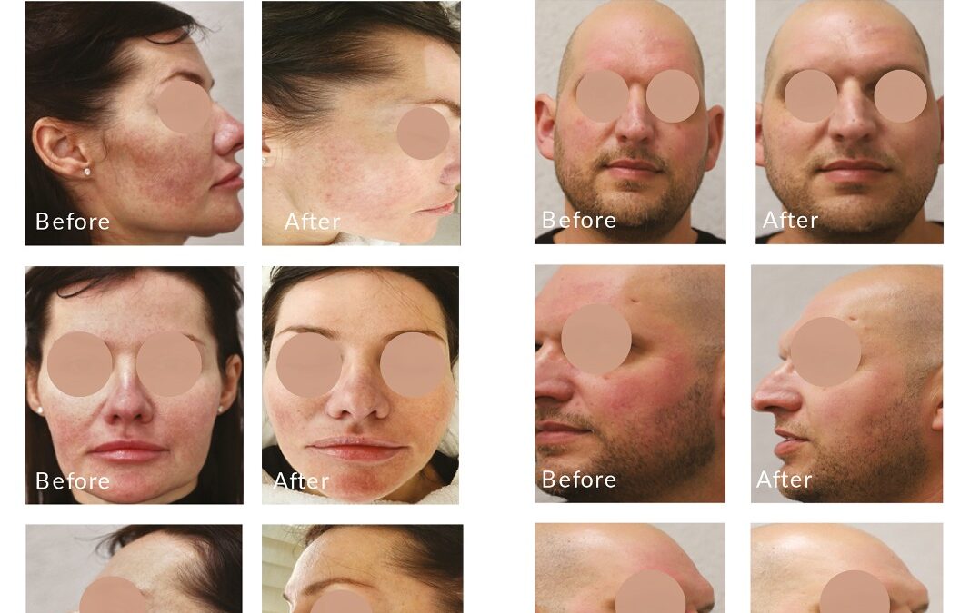 New Clinical Evidence for Rosacea: Alpha Pro 3D IPL in Focus