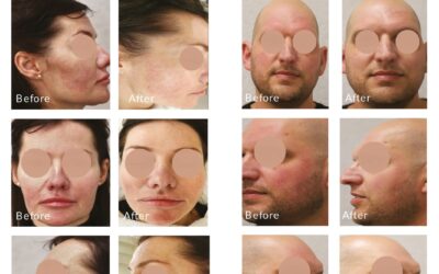 New Clinical Evidence for Rosacea: Alpha Pro 3D IPL in Focus