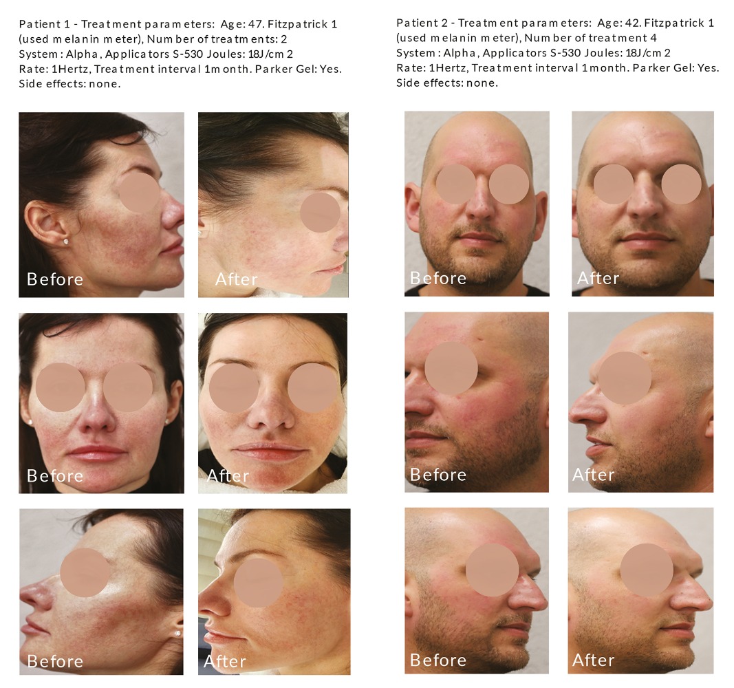 Alpha Pro 3D IPL in Focus Alpha Pro 3D IPL in Focus