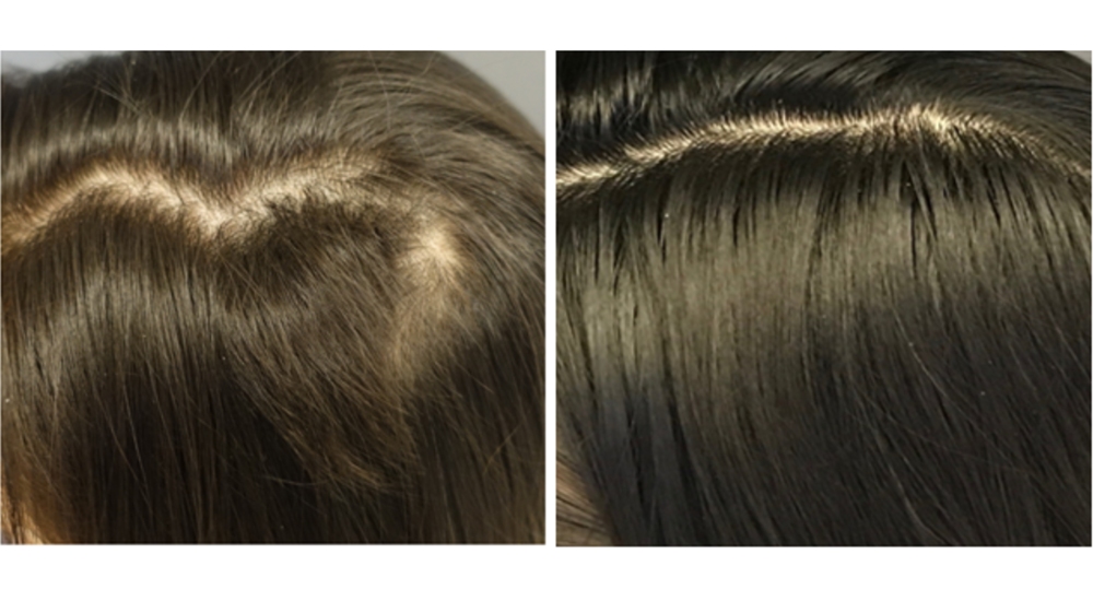 After One year of treatment