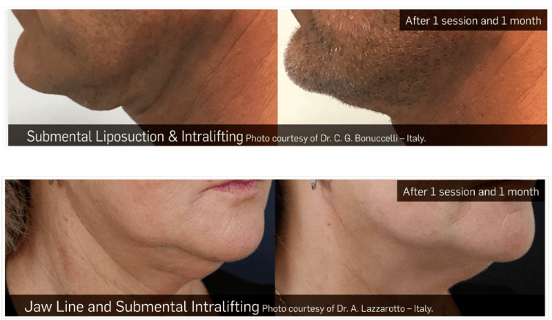 InLift Before & After