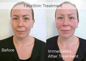 Before and after FaceStim treatment