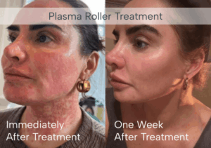 Before and after plasma roller